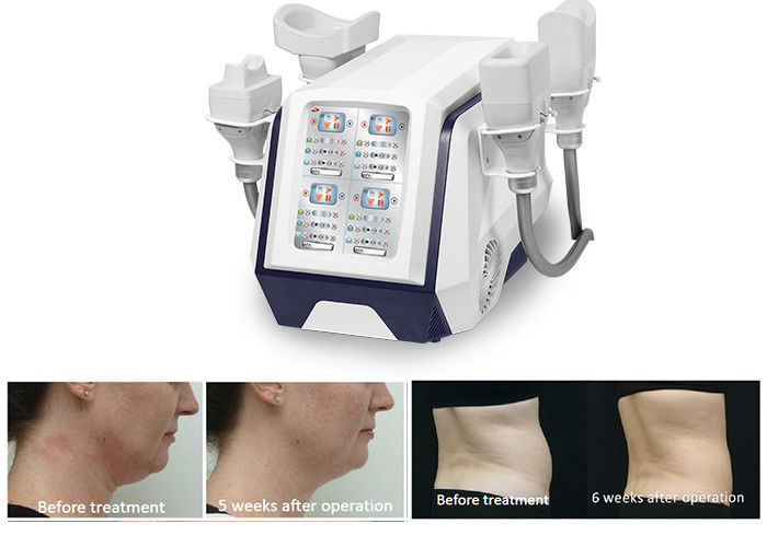 Corpo di Cryolipolysis del portatile 360 che dimagrisce macchina 1000W per perdita di peso bruciante grassa